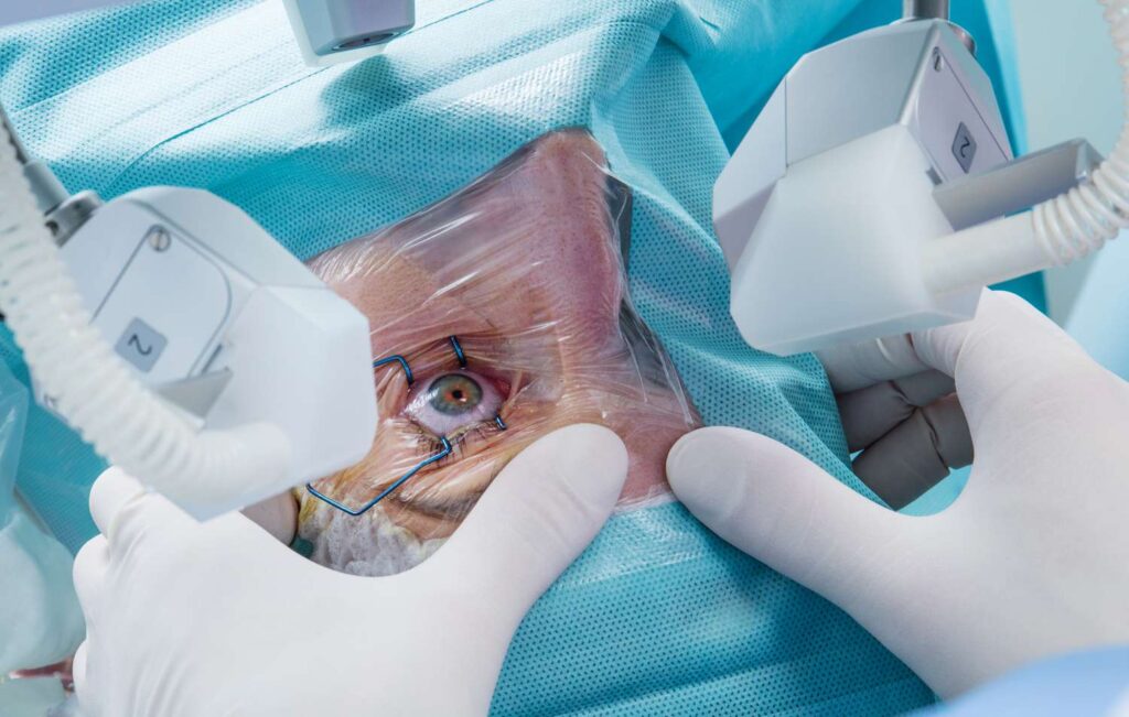 Laser Eye Surgery2 laser eye surgery